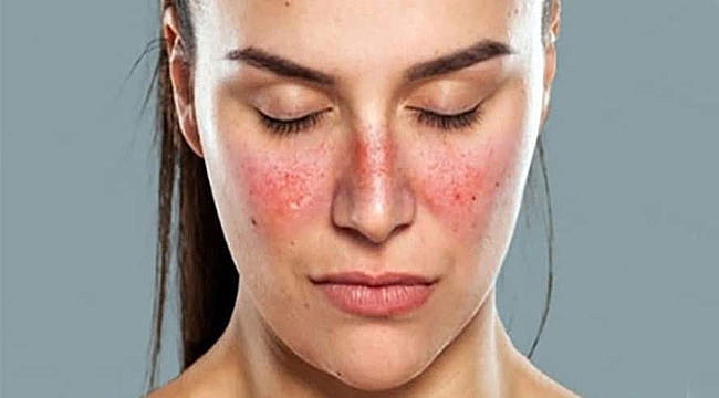 Stres ile birlikte ortaya çıkıyor; Lupus hastalığı