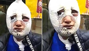 Eski sözlüsünün başından kızgın yağ döken sanık tahliye edildi