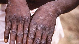 Halk Sağlığı Genel Müdürlüğü'nden Maymun Çiçeği virüsü açıklaması! 