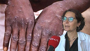 Maymun çiçeği virüsü ile ilgili çarpıcı iddia! Karantina 28 gün sürebilir