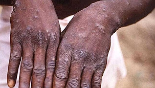 Sağlık Bakanı Koca'dan flaş açıklama! Maymun Çiçeği virüsü pandemiye yol açar mı?