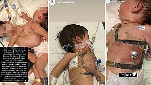 Aynı bedende nefes alan siyam ikizleri 9 saatlik ameliyatın ardından...