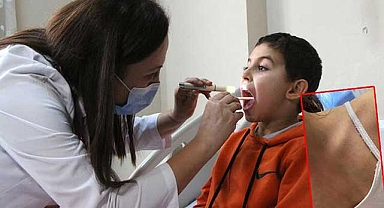 Çocuklardaki kızıl vakalar strep A belirtisi olabilir