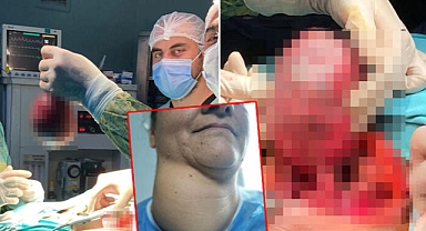 Yıllarca ameliyattan korkan hasta ikna edildi, boynundan 800 gram kitle çıktı