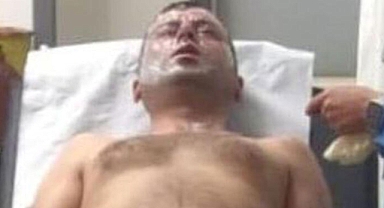 Lavabo açıcı yüzüne patladı! 