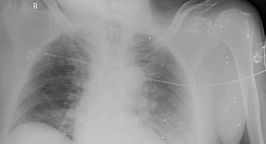 Vücudunda 300' yakın saçma bulunan Osman Yıldırım'ı ağabeyi vurmuş!