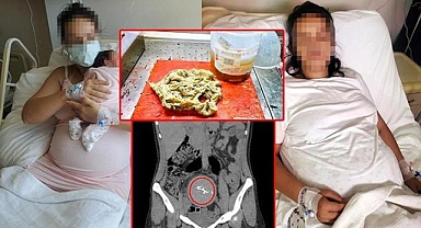 Doğumda vücudunda gazlı bez unuttular, 2 yıl sonra ameliyatla çıkarıldı