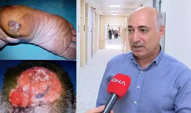 Cilt Kanseri Farkındalık Ayı'nda uzmanından uyarı!