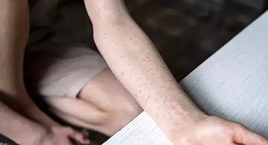 Kızamık vakaları abd de artıyor 