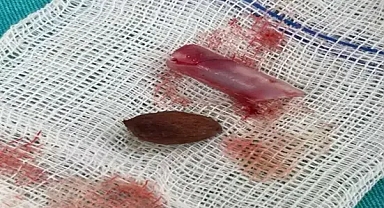 11 yaşında ki otizmli çocuğun burnundan çekirdek ve pipet parçaşı çıkarıldı