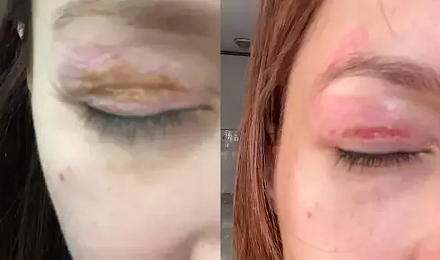 Güzellik salonundaki işlem sonrası gözünde hasar iddiasıyla yaptığı şikayet reddedildi; 'Uzmanına gidin' uyarısı yaptı