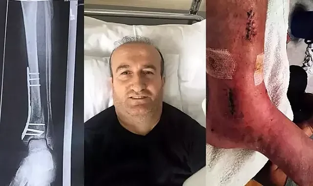 Arkeolojik kazı alanındaki çukura düşünce ayağında yüzde 3'lük engel oluştu; 1 milyon lira tazminat kararı çıktı