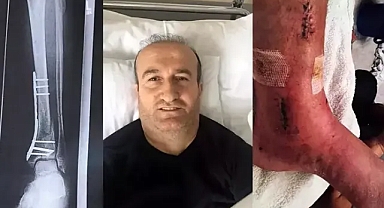 Arkeolojik kazı alanındaki çukura düşünce ayağında yüzde 3'lük engel oluştu; 1 milyon lira tazminat kararı çıktı