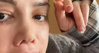 Yüz nakli yaptırdı, kaşında saç çıktı...