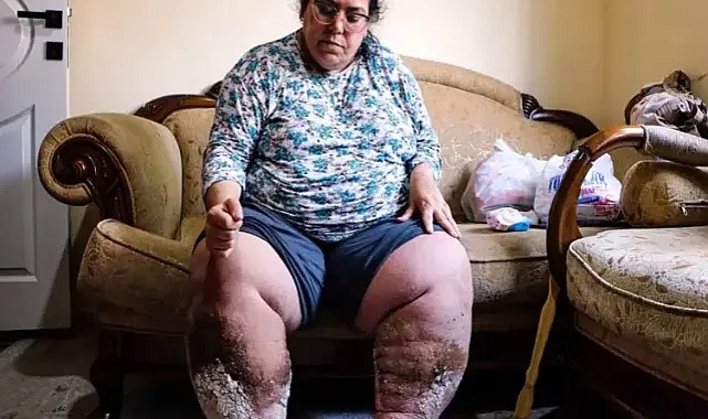 Fil hastalığı hayatını esir aldı, yetkililerden yardım bekliyor!